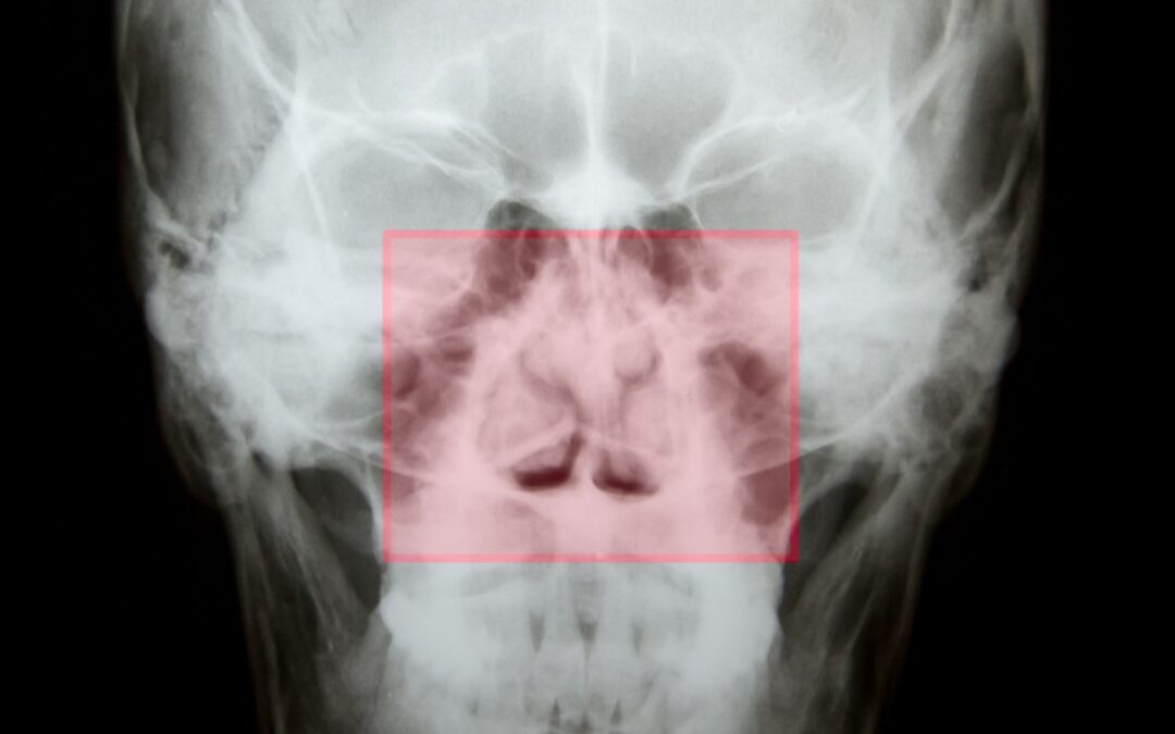 Can a Deviated Septum Cause Sleep Apnea?